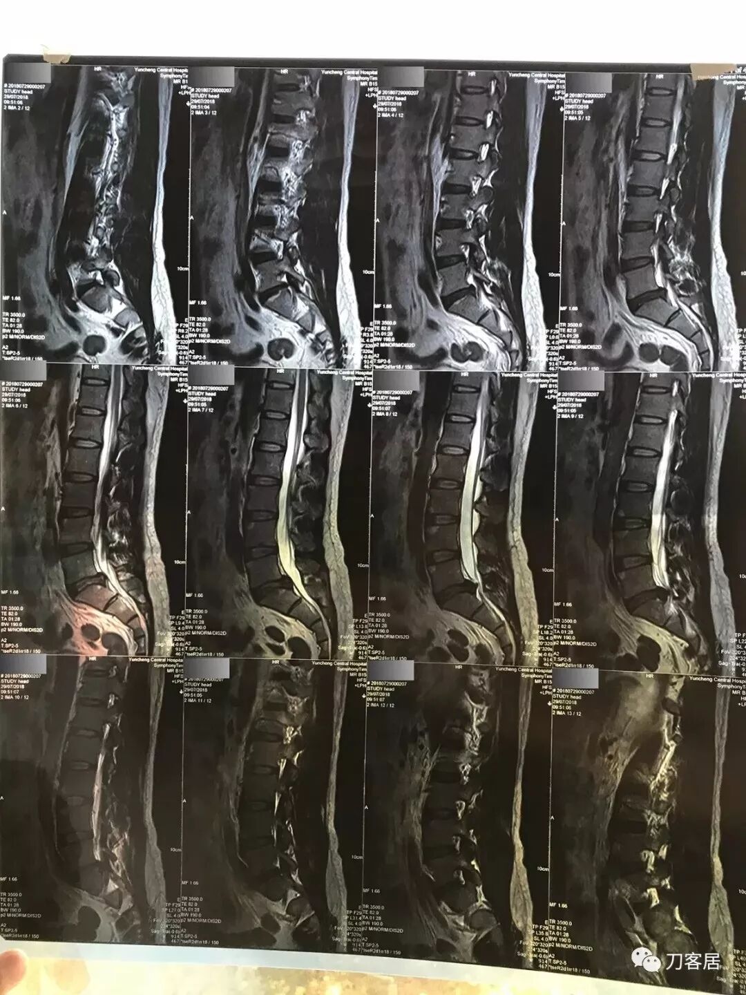 医用阅片灯是什么专业科普！简单又实用的X线片翻拍技术，我只偷偷告诉你_https://www.jmylbn.com_新闻资讯_第5张