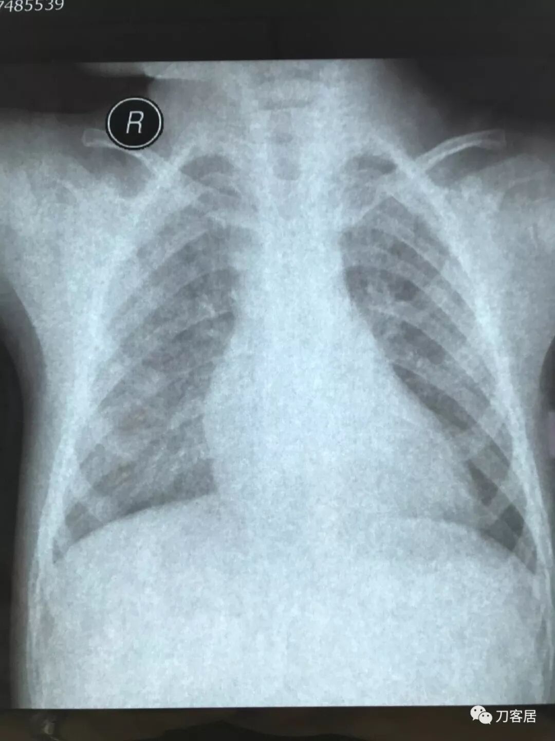 医用阅片灯是什么专业科普！简单又实用的X线片翻拍技术，我只偷偷告诉你_https://www.jmylbn.com_新闻资讯_第18张