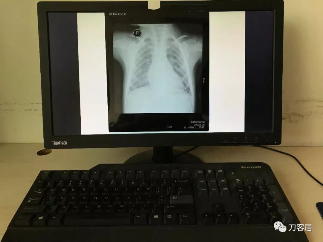 医用阅片灯是什么专业科普！简单又实用的X线片翻拍技术，我只偷偷告诉你_https://www.jmylbn.com_新闻资讯_第14张