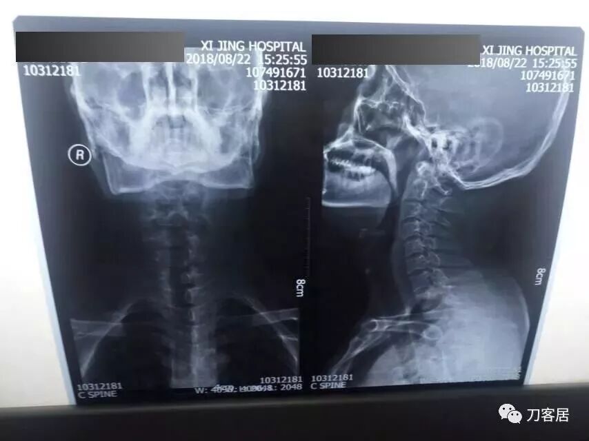 医用阅片灯是什么专业科普！简单又实用的X线片翻拍技术，我只偷偷告诉你_https://www.jmylbn.com_新闻资讯_第7张