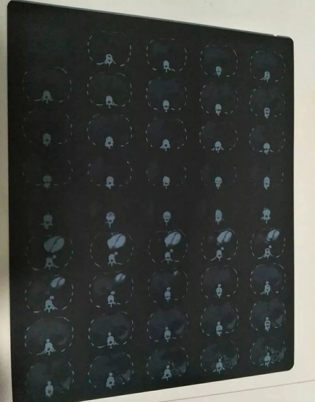 医用阅片灯是什么专业科普！简单又实用的X线片翻拍技术，我只偷偷告诉你_https://www.jmylbn.com_新闻资讯_第4张