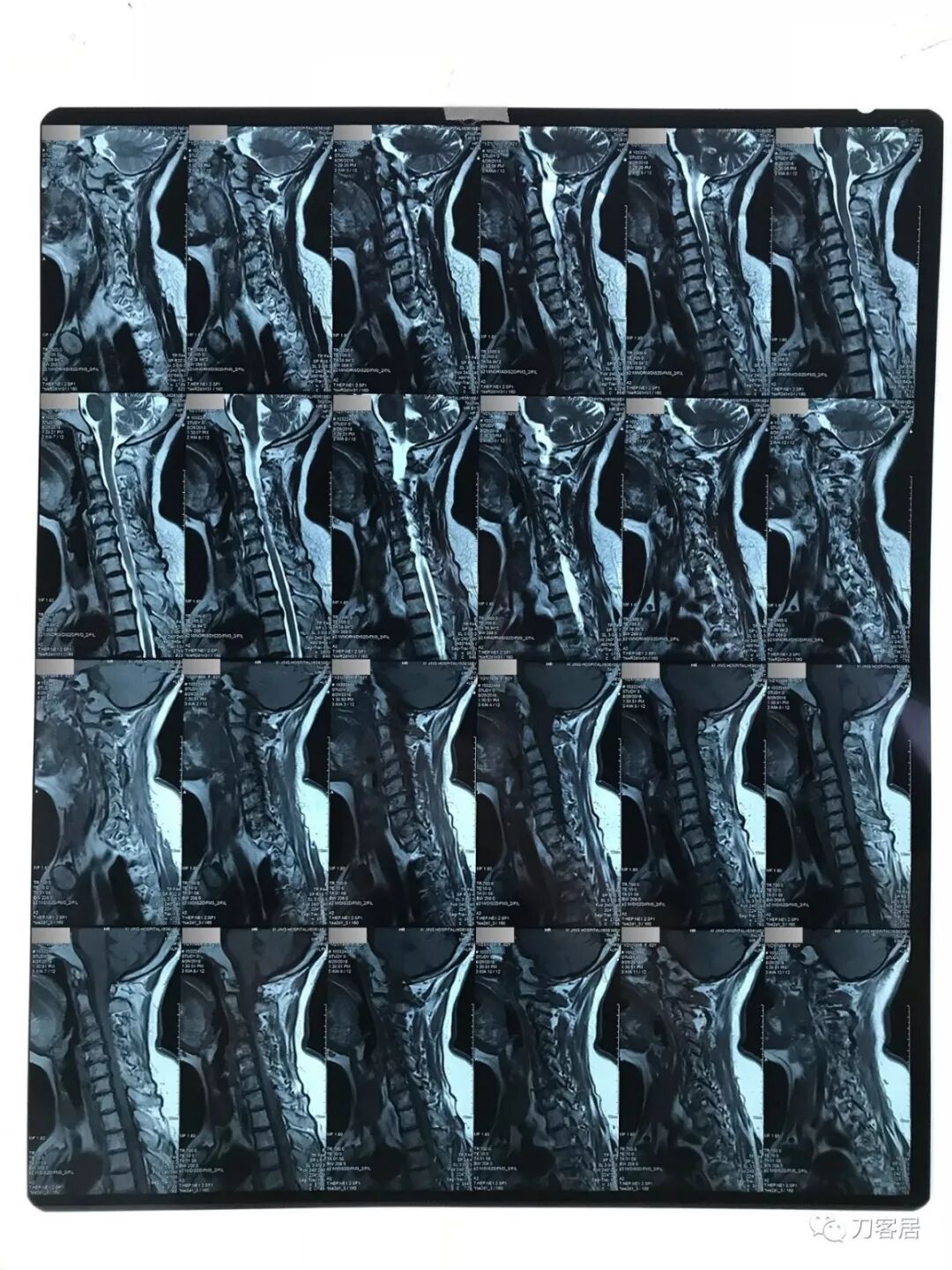 医用阅片灯是什么专业科普！简单又实用的X线片翻拍技术，我只偷偷告诉你_https://www.jmylbn.com_新闻资讯_第22张