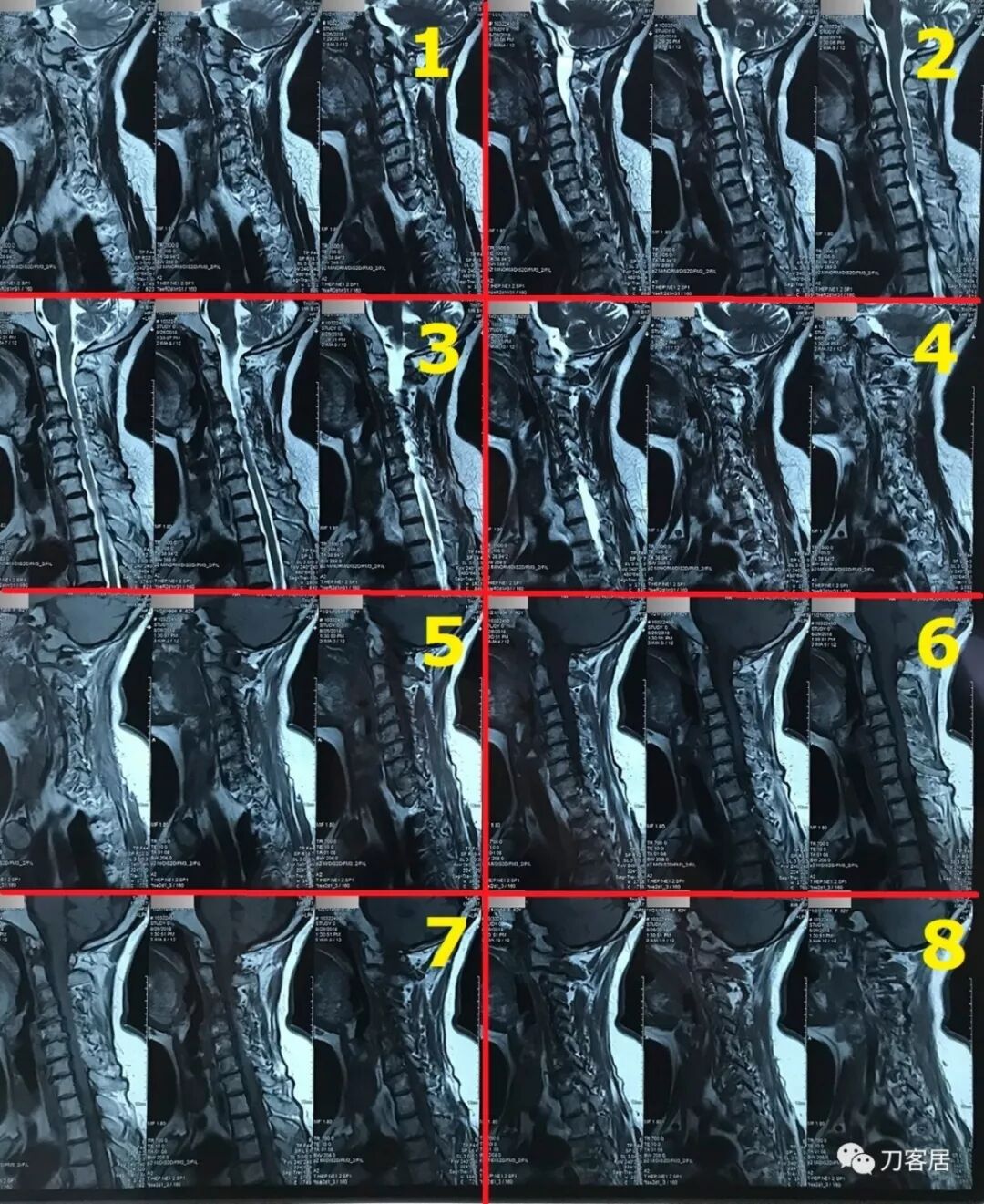医用阅片灯是什么专业科普！简单又实用的X线片翻拍技术，我只偷偷告诉你_https://www.jmylbn.com_新闻资讯_第23张