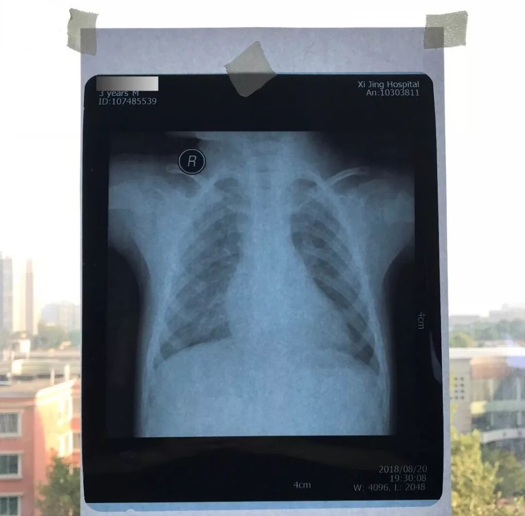 医用阅片灯是什么专业科普！简单又实用的X线片翻拍技术，我只偷偷告诉你_https://www.jmylbn.com_新闻资讯_第13张