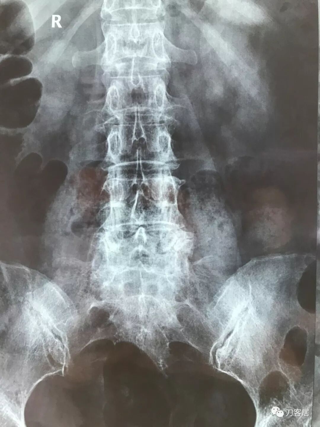 医用阅片灯是什么专业科普！简单又实用的X线片翻拍技术，我只偷偷告诉你_https://www.jmylbn.com_新闻资讯_第20张