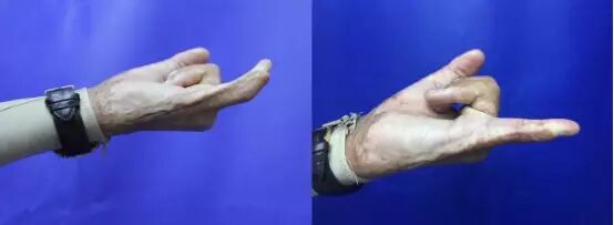 二氧化碳(co2)激光治疗是什么瘢痕的“克星”——超脉冲co2点阵激光_https://www.jmylbn.com_新闻资讯_第12张