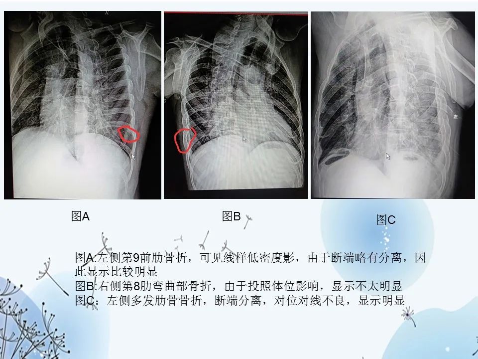 肋骨斜位的投照方法图图片