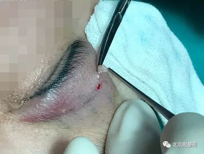 微创小切口去脂 埋线双眼皮手术操作全程|双眼皮|去脂|脂肪_新浪女性_