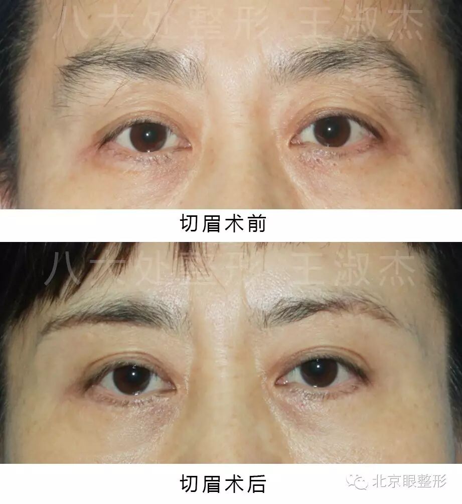 美眉,祛皱,大眼特效功能的切眉术!(附案例)