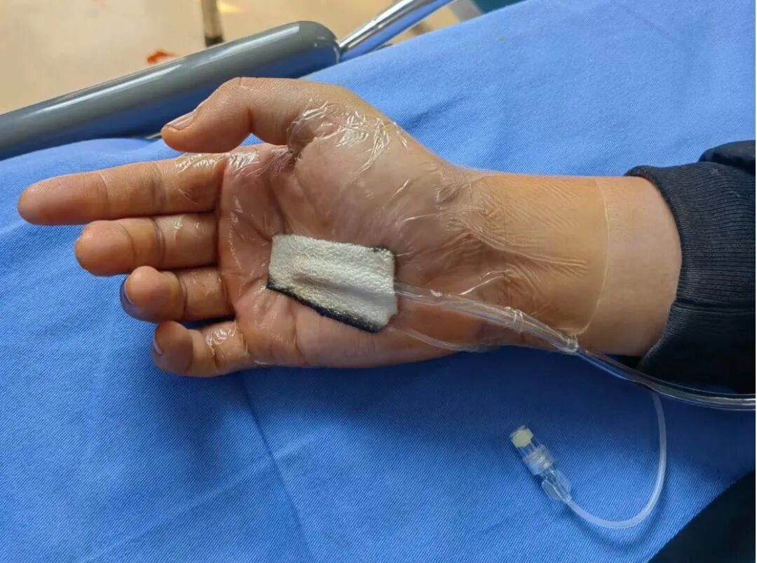 怎么促进vsd伤口愈合爱犬啊呜一口，手掌血肉模糊，巧用VSD技术治疗_https://www.jmylbn.com_新闻资讯_第6张