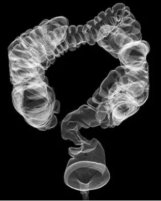 胃造影用的是什么机子【科普园地】胃肠机透视胃肠道病变，影像科创新技术助力健康_https://www.jmylbn.com_新闻资讯_第7张