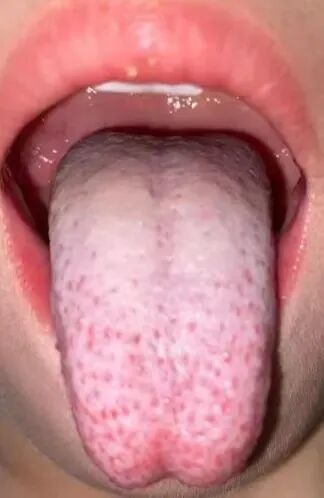 重磅丨经方治疗肺炎支原体思路及总结，深度讲述咳嗽、发热临床体会