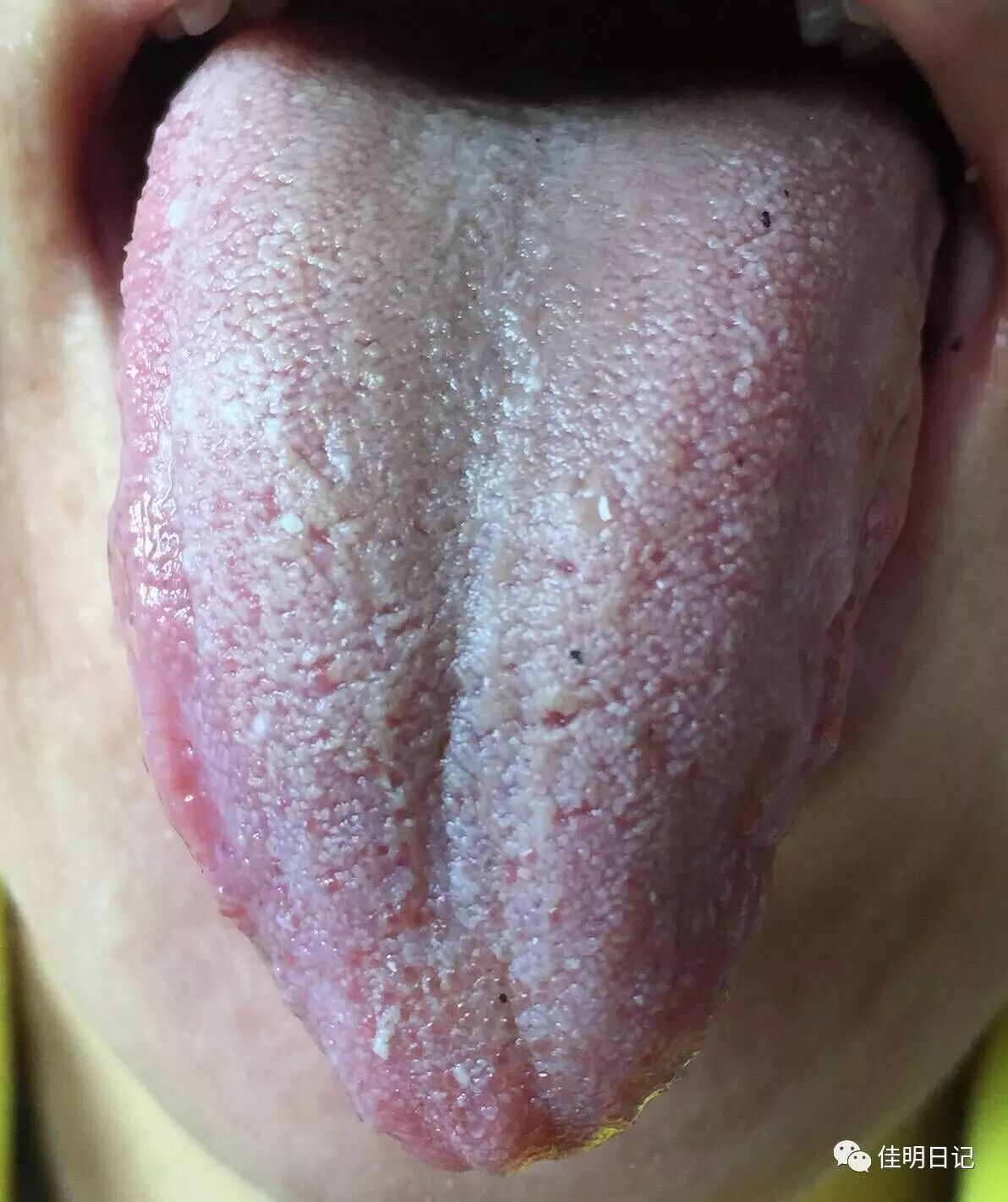 小柴胡汤半夏厚朴汤治疗抑郁症