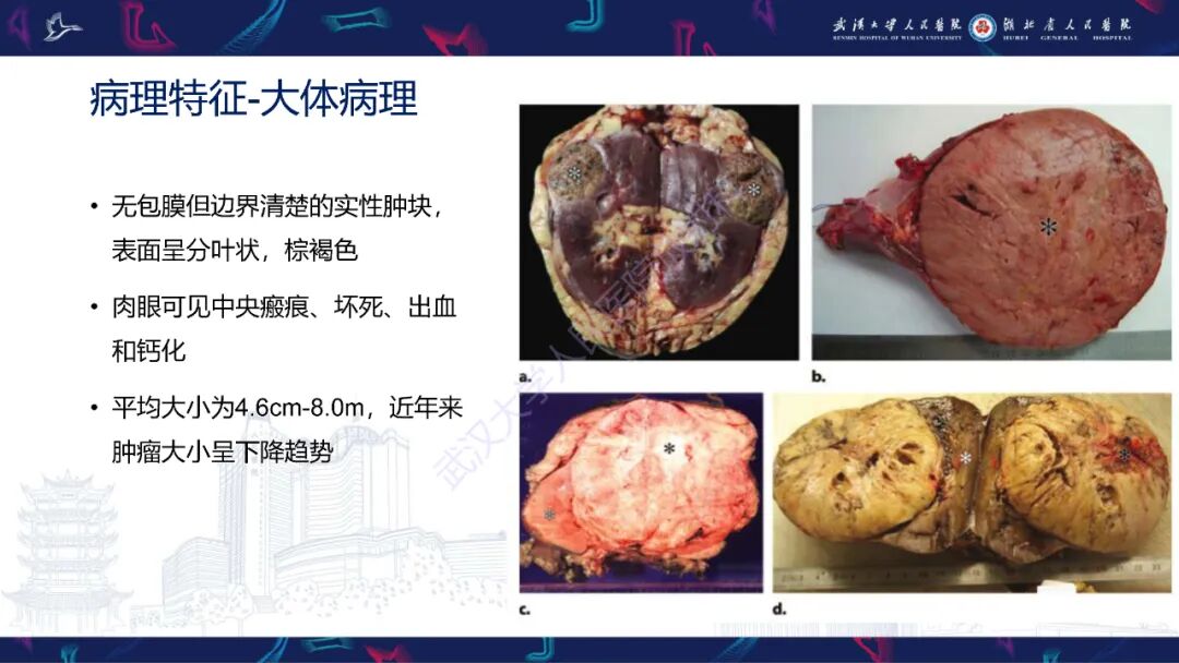 肾嫌色细胞癌影像诊断