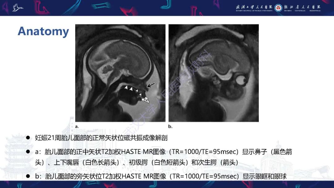 胎儿面部畸形mr诊断 鼎湖影像 微信公众号文章 微小领