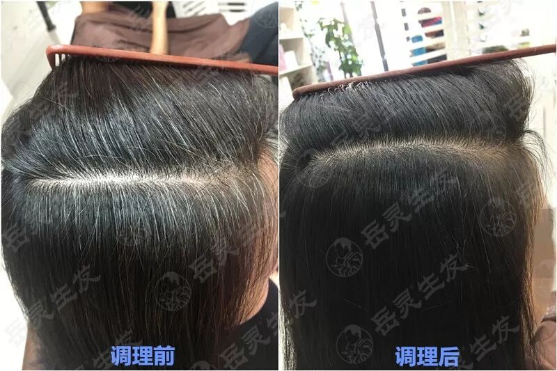 岳灵生发白发转黑实例