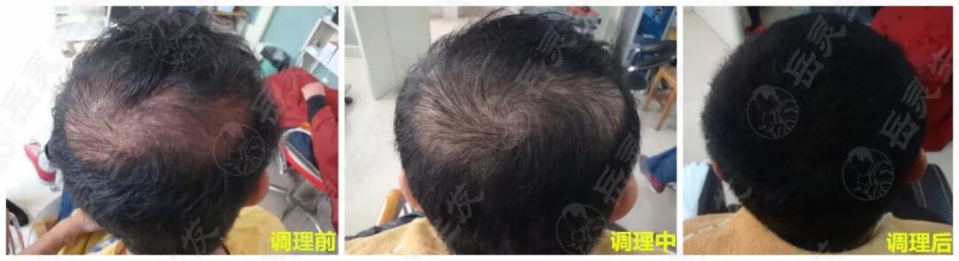 岳灵生发毛囊炎恢复实例