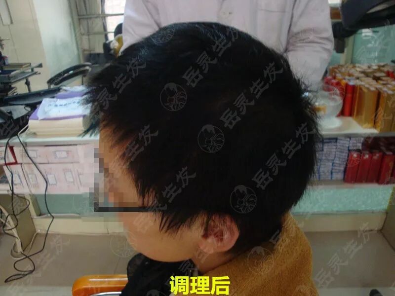 岳灵生发女性脱发调理后