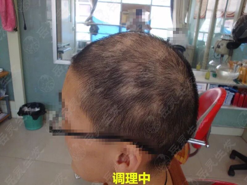 岳灵生发女性脱发调理中