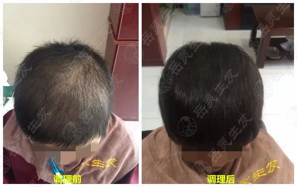 岳灵生发脱发再生对比