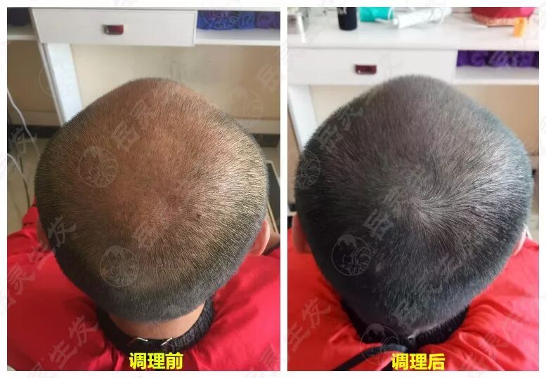 岳灵生发脱发再生实例