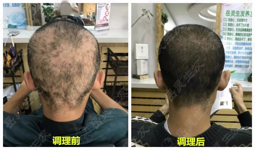 岳灵生发辽宁沈阳店斑秃恢复实例