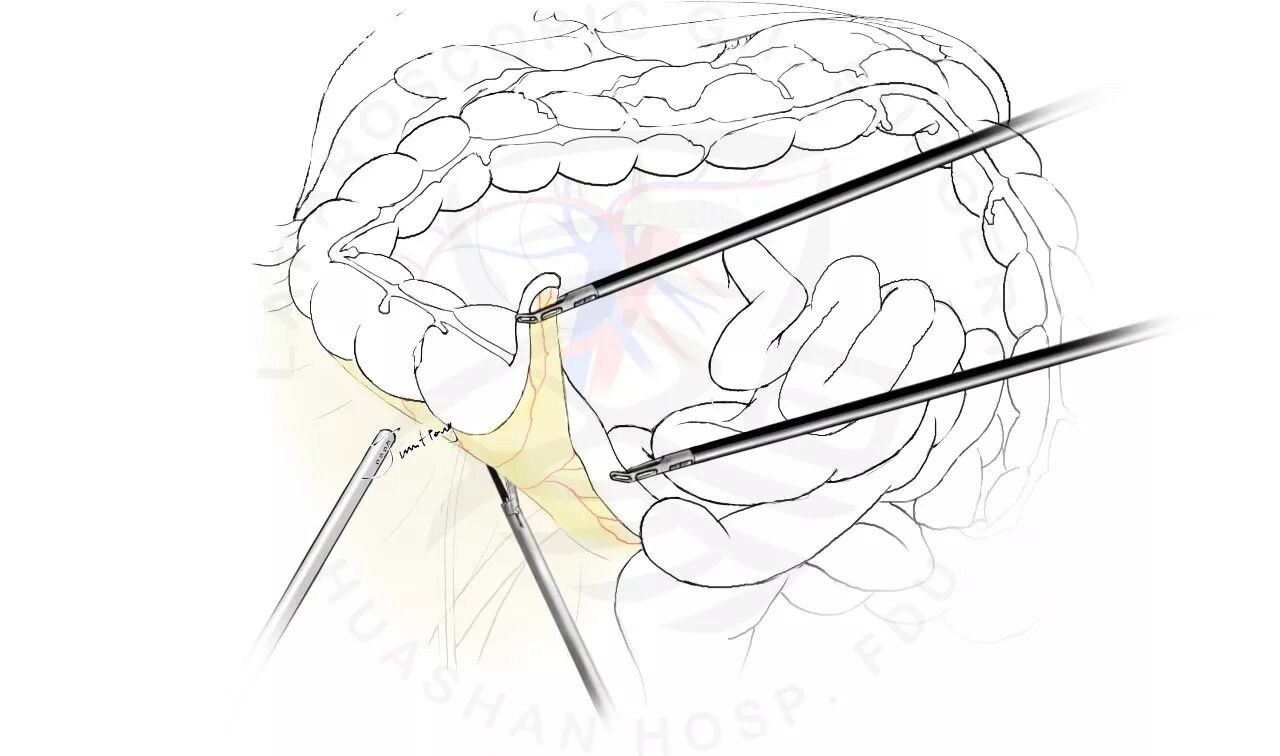 图解"全腹腔镜下右半结肠切除术" - 好大夫在线
