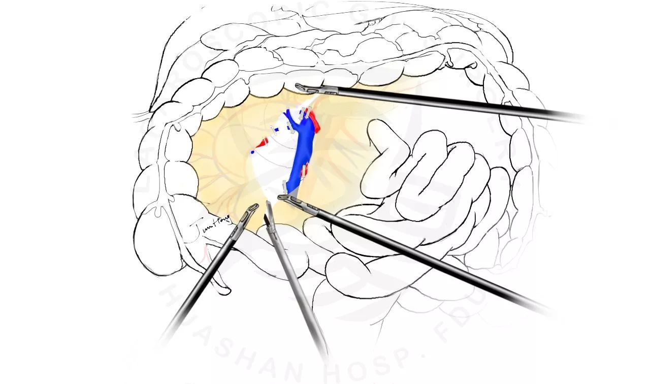 圖解全腹腔鏡下右半結腸切除術