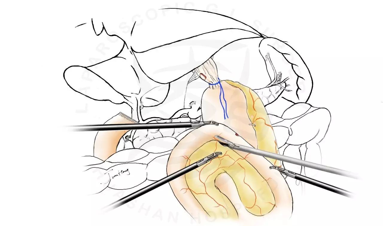 图解splt——全腹腔镜全胃切除后重建的新方式 
