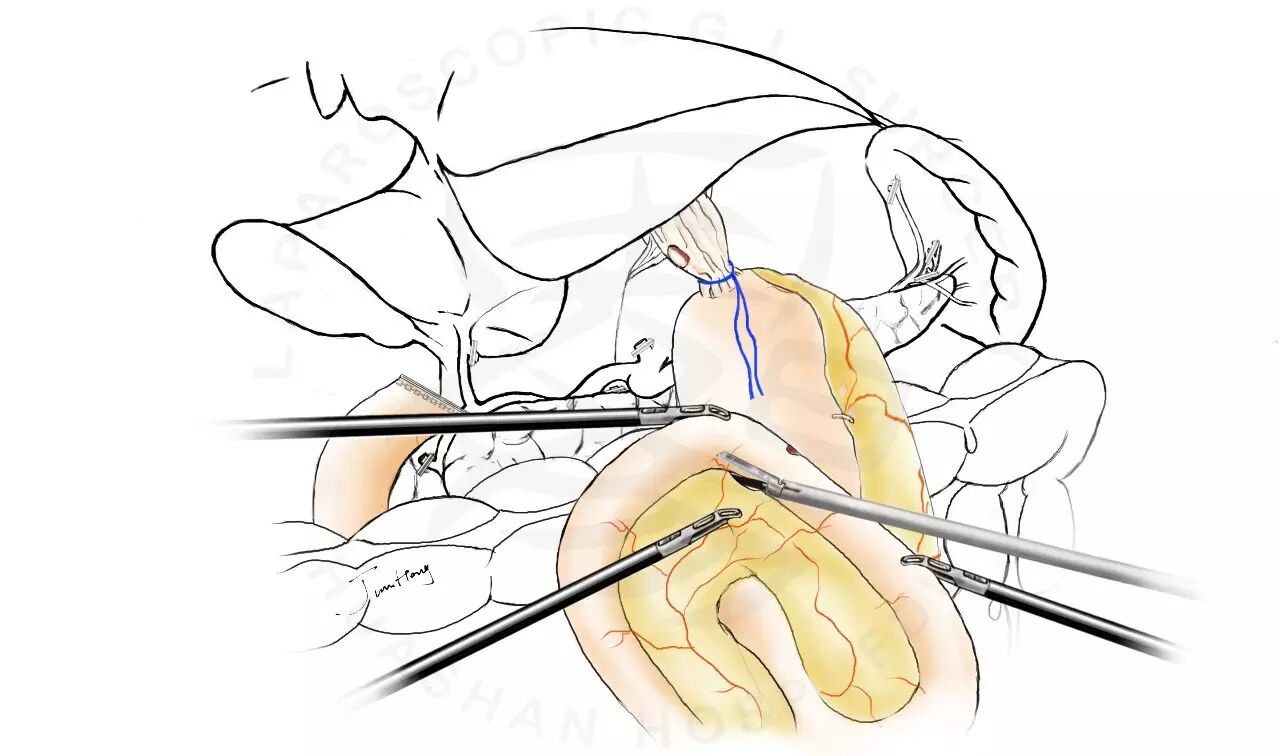 图解splt——全腹腔镜全胃切除后重建的新方式