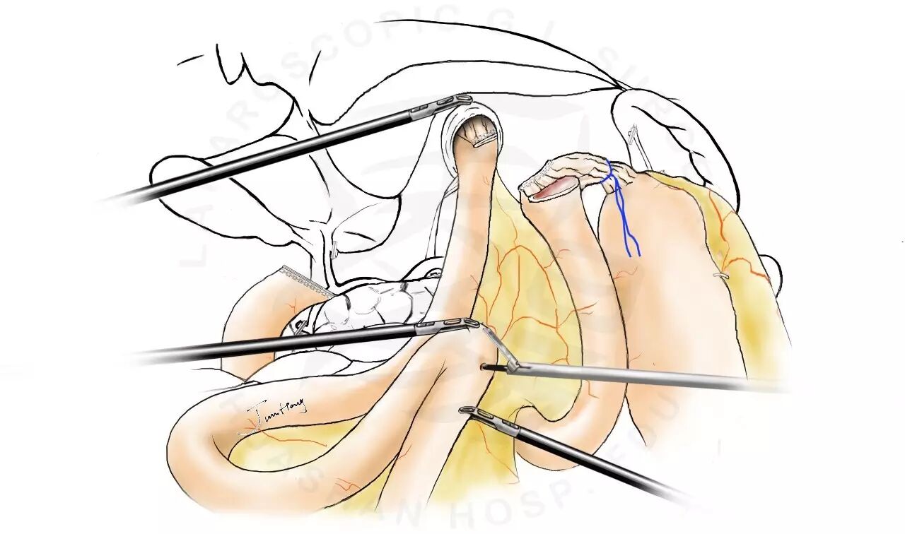 利用e-j共同开口行空肠-空肠侧侧吻合(j-j)15.关闭j-j共同开口16.