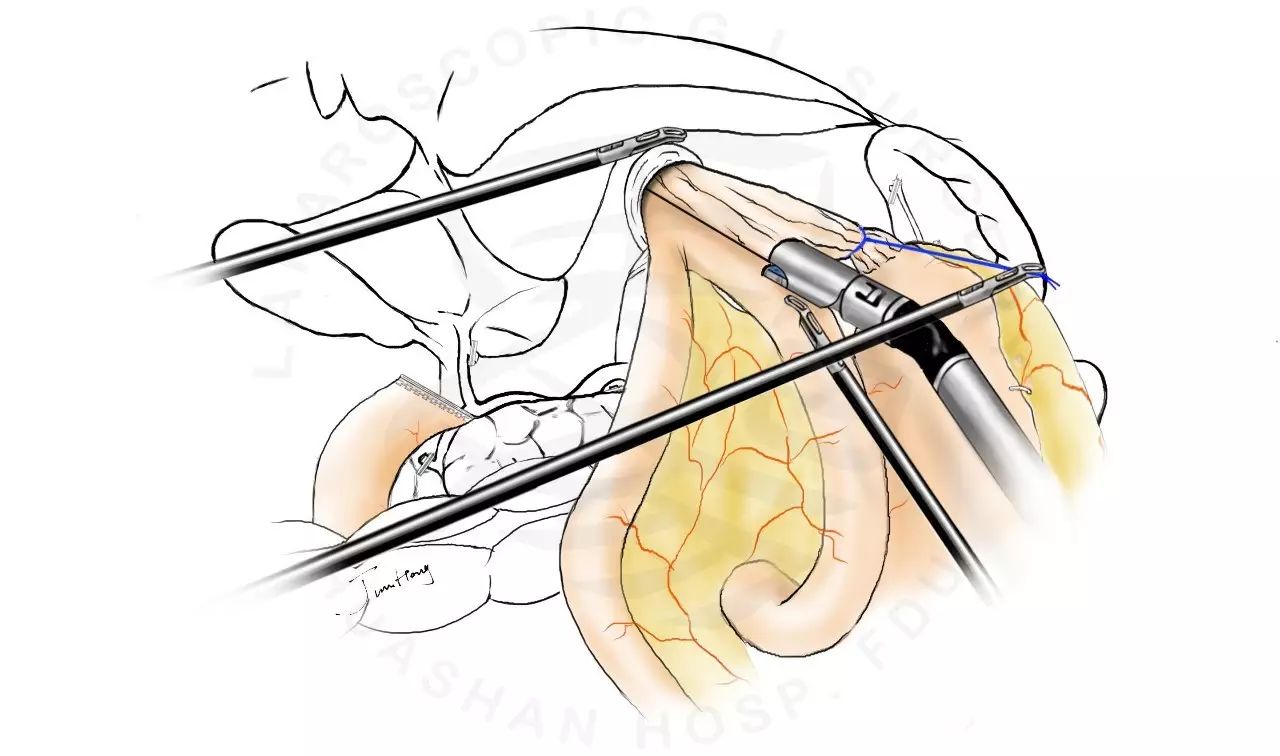 圖解splt——全腹腔鏡全胃切除後重建的新方式 - 好大夫在線