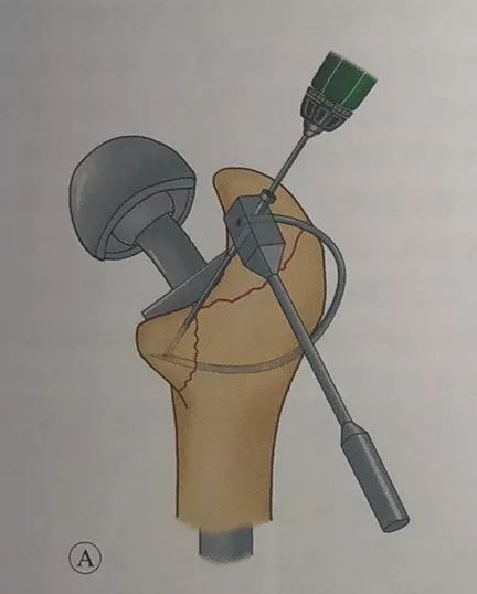 股骨转子间骨折人工股骨头置换术