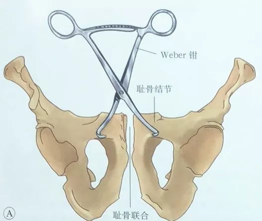 骨盆骨折的orif 骨视新野 微信公众号文章阅读 Wemp