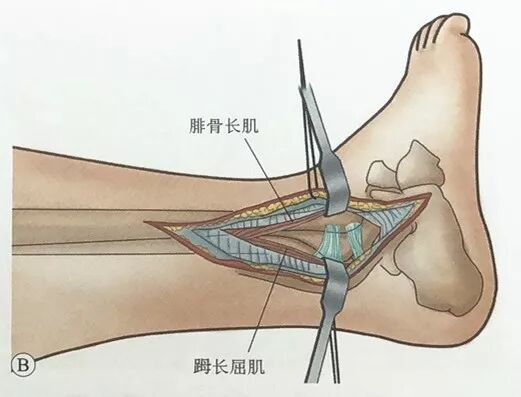 踝关节骨折手术治疗技巧 医贰叁云学院 微信公众号文章阅读 Wemp