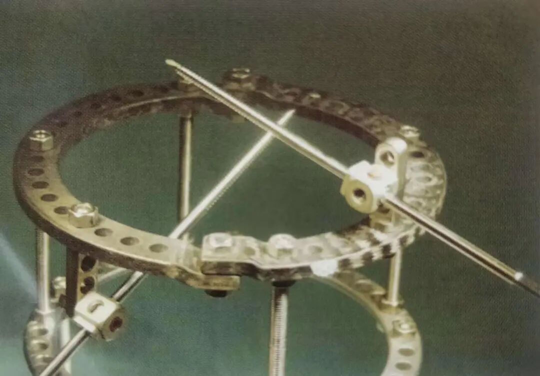 什么是外固定架胫骨近端骨折：环形外固定架_https://www.jmylbn.com_新闻资讯_第34张