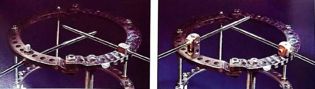 什么是外固定架胫骨近端骨折：环形外固定架_https://www.jmylbn.com_新闻资讯_第33张