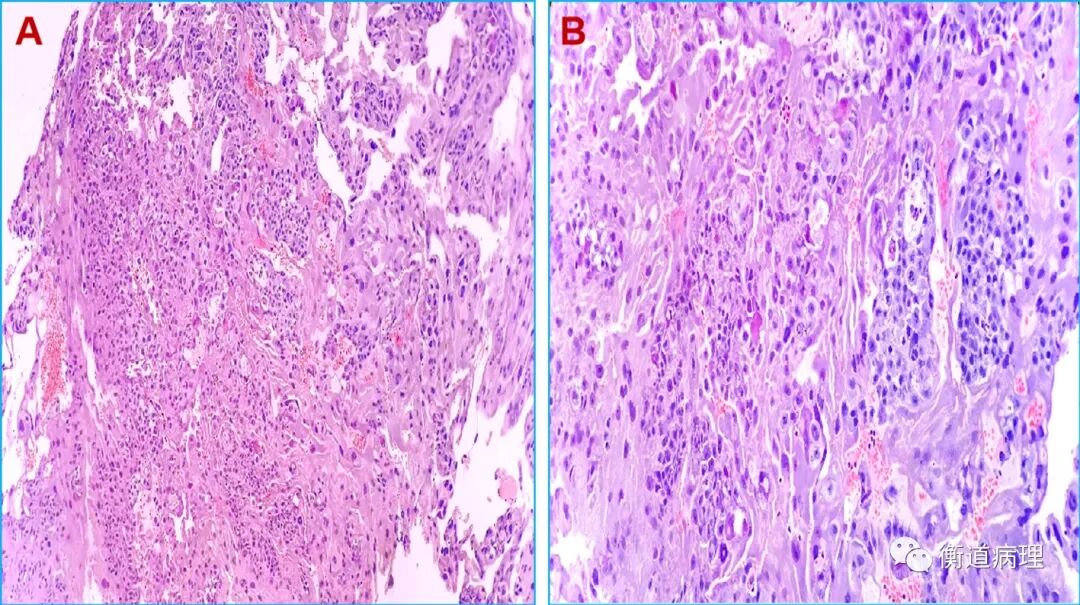 【衡道丨干货】生殖细胞肿瘤之卵巢和睾丸中相似的生殖细胞肿瘤（下）