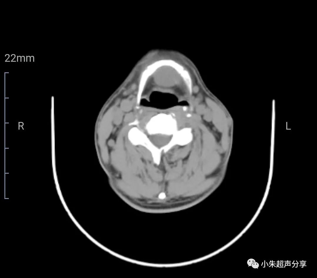 甲状舌管囊肿