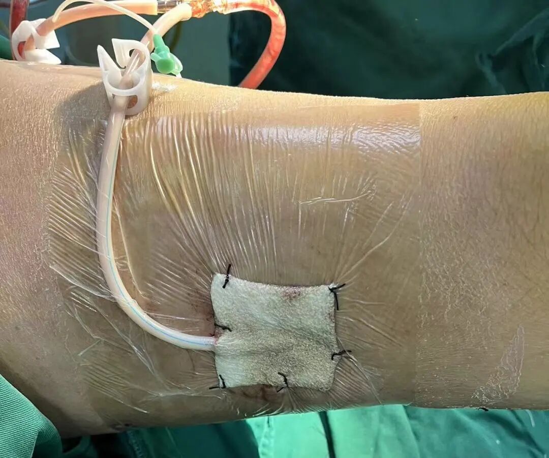 负压引流是什么什么是Vsd负压引流术？_https://www.jmylbn.com_新闻资讯_第3张