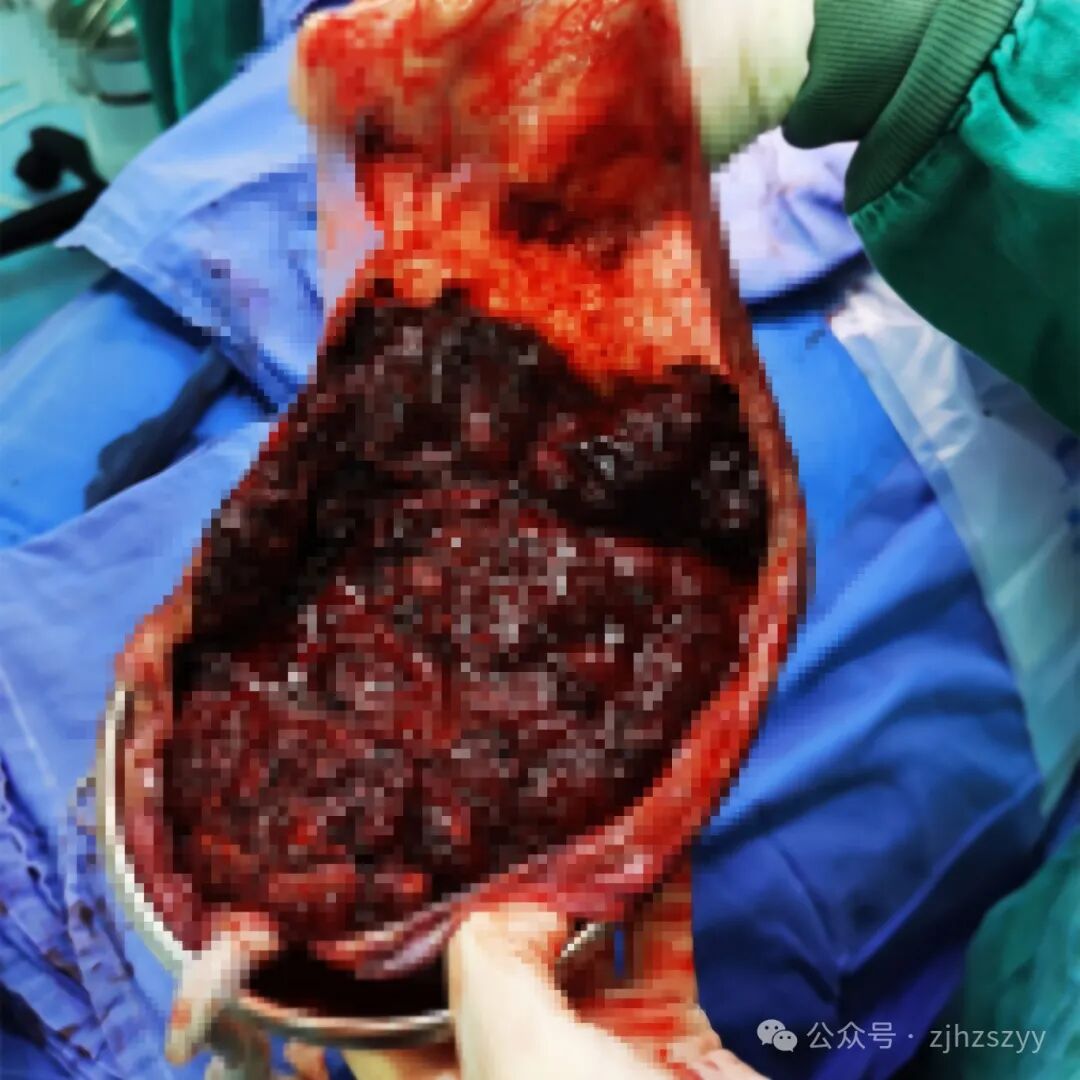 止血纱布怎么用止血纱布用了三排、整个器官青紫……这个位置“动”一下，差点命都没了_https://www.jmylbn.com_新闻资讯_第4张