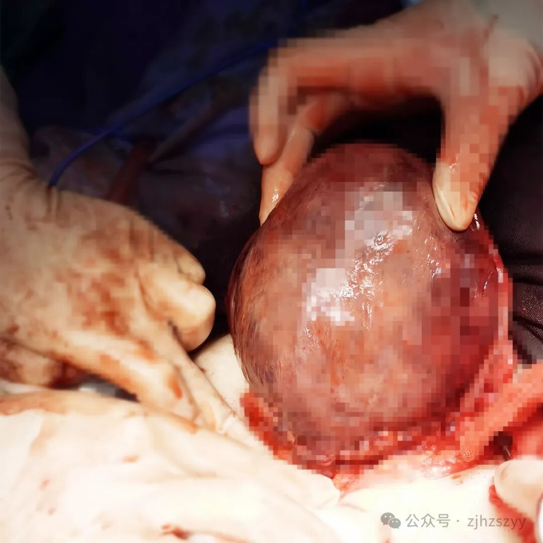 止血纱布怎么用止血纱布用了三排、整个器官青紫……这个位置“动”一下，差点命都没了_https://www.jmylbn.com_新闻资讯_第3张