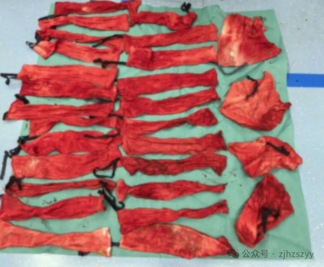 止血纱布怎么用止血纱布用了三排、整个器官青紫……这个位置“动”一下，差点命都没了_https://www.jmylbn.com_新闻资讯_第5张