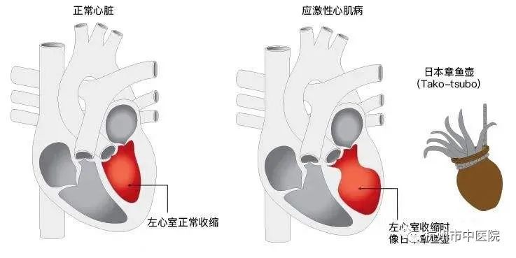 如果将大多数应激性心肌病患者的心脏放在超声下看，会发现患者的心尖部
