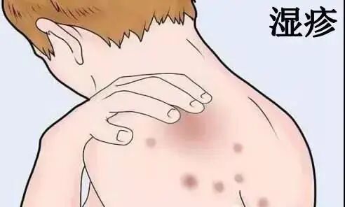 什么是窄谱紫外线治疗窄谱紫外线光疗仪让“牛皮癣”不再牛皮_https://www.jmylbn.com_新闻资讯_第6张