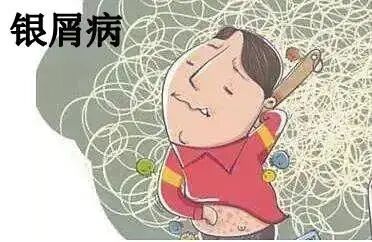 什么是窄谱紫外线治疗窄谱紫外线光疗仪让“牛皮癣”不再牛皮_https://www.jmylbn.com_新闻资讯_第5张