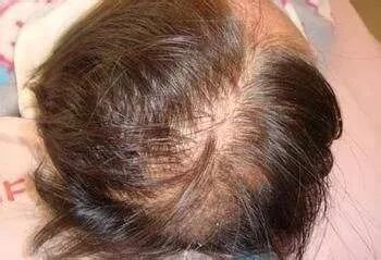 毛囊退化的原因