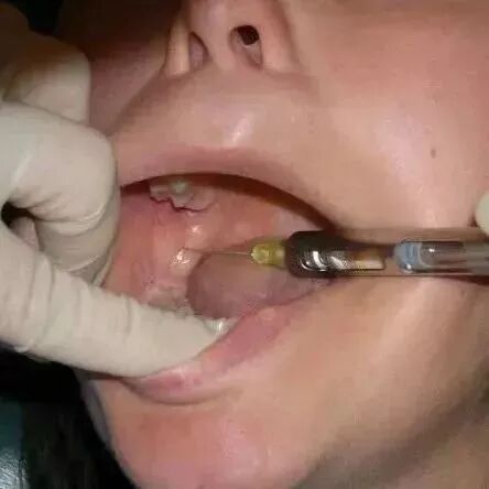 小孩子拔牙可以用麻药吗？