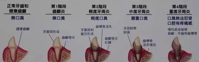 牙结石为什么那么臭-3.jpg