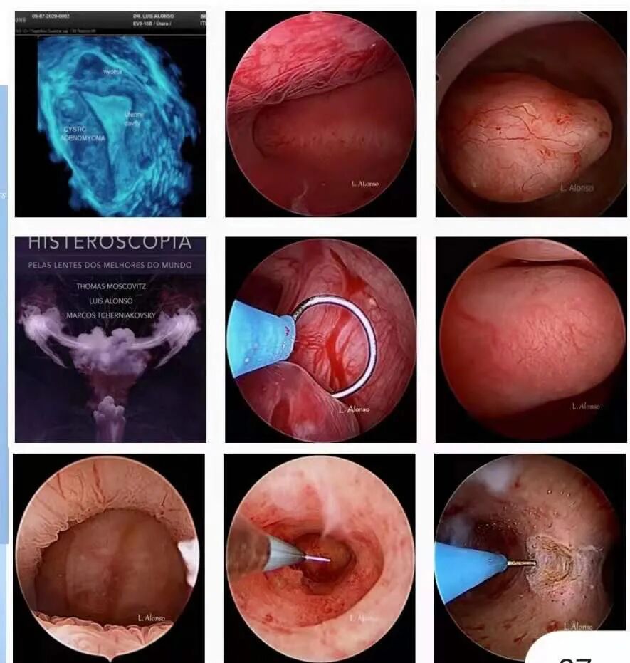 宫腔镜器械怎么组装每周一课｜注重细节、精准诊疗——谈宫腔镜冷刀技术在门诊即诊即治中的应用_https://www.jmylbn.com_新闻资讯_第2张